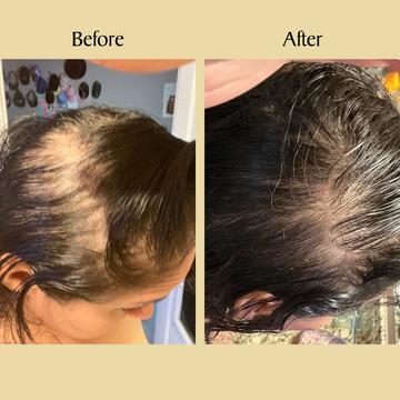Before and after images showing hair regrowth progress.